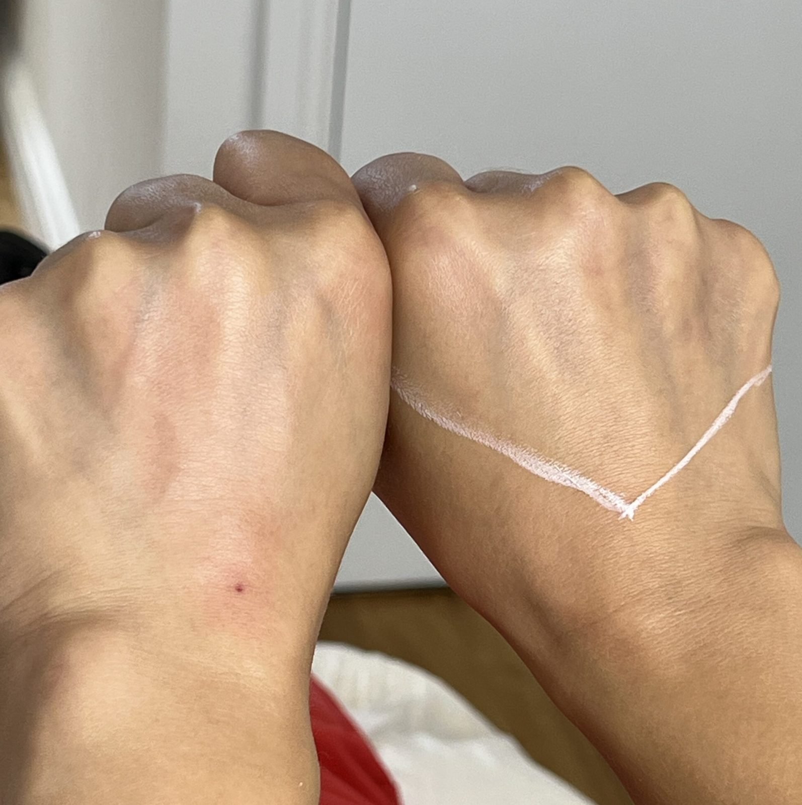 skin booster injection in london and treatment for glowing skin and reducing wrinkle