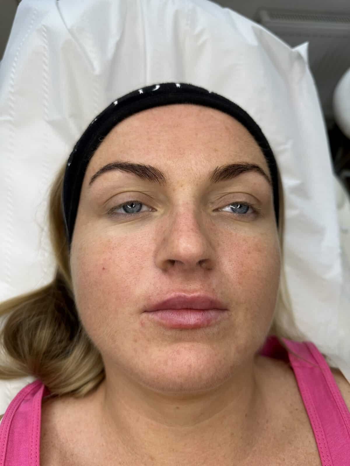 women after lip filler effect