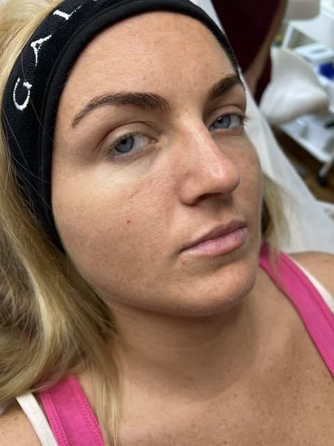 women zoom face before lip filler
