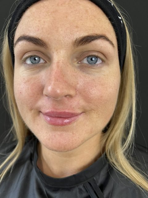 women show smile after lip filler