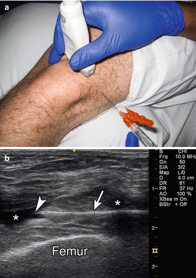 What is Corticosteroid Injection